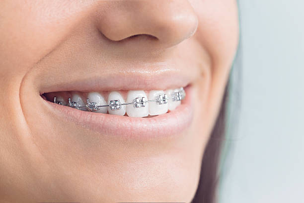 Best Veneers and Lumineers  in Mack, OH